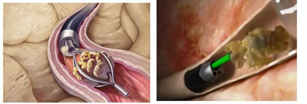 laser-ureterolitotripsy