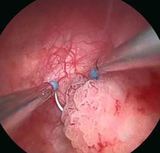 transurethral-resection-bladder-tumor