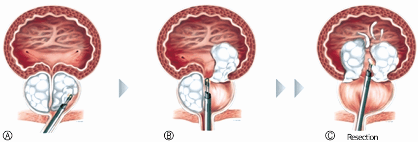 bipolar-resection-prostatae