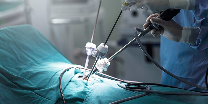 laparoscopy-ureterulitotomy