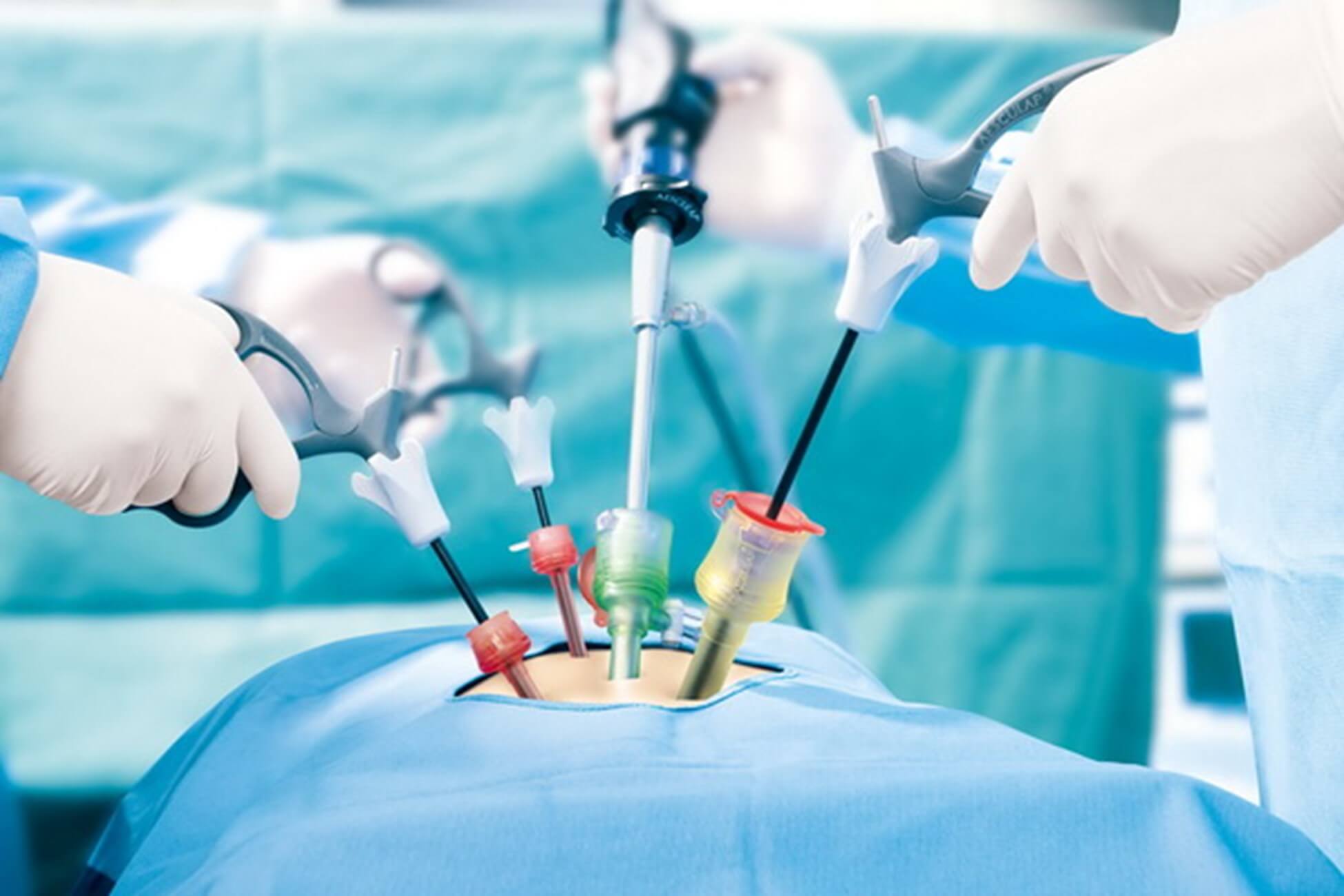laparoscopy-resection-pochek