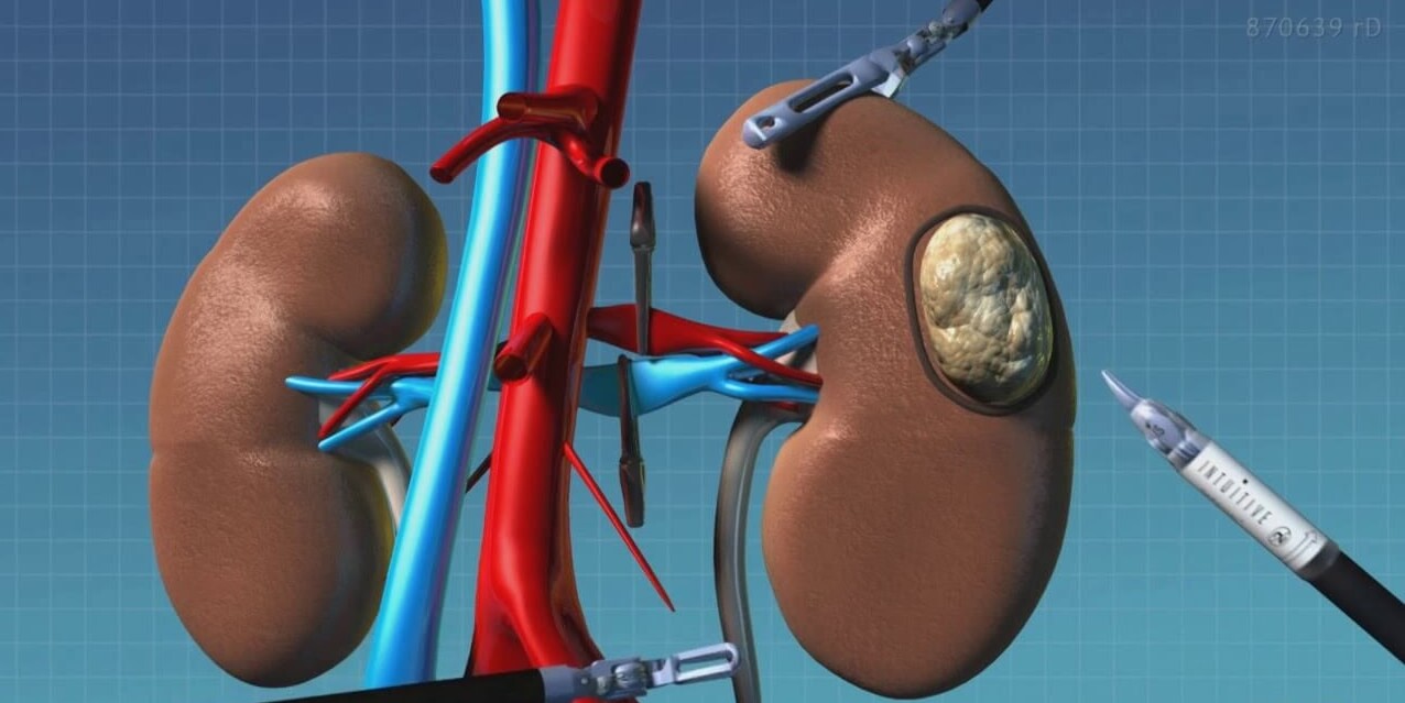 laparoscopy-resection-pochki